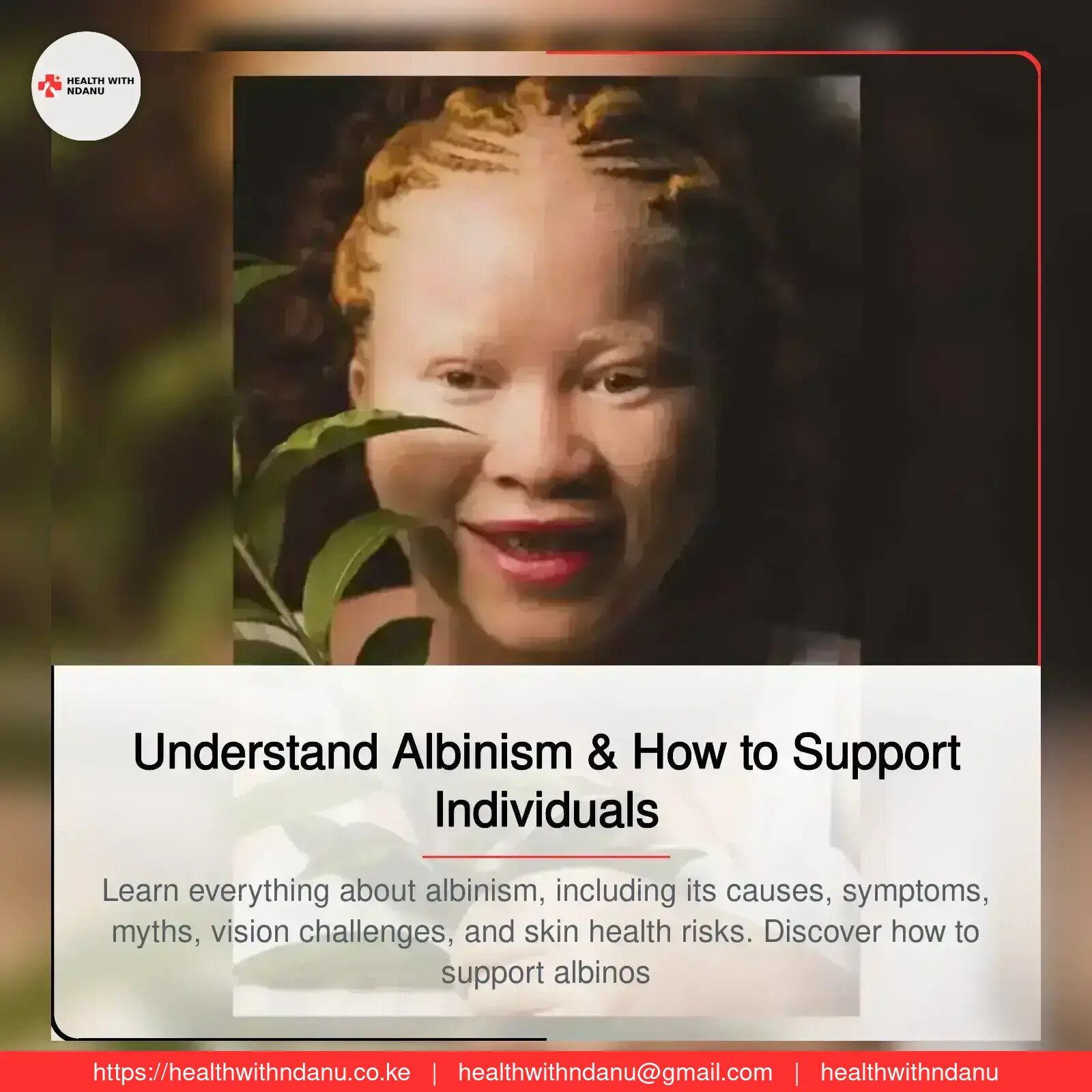 Understand Albinism & How to Support Individuals