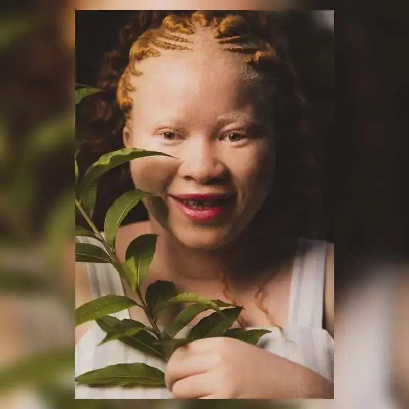Understand Albinism & How to Support Individuals