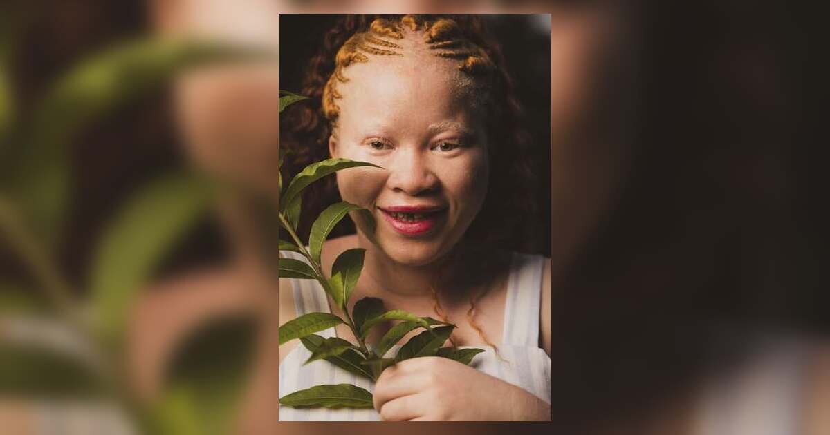 Understand Albinism & How to Support Individuals