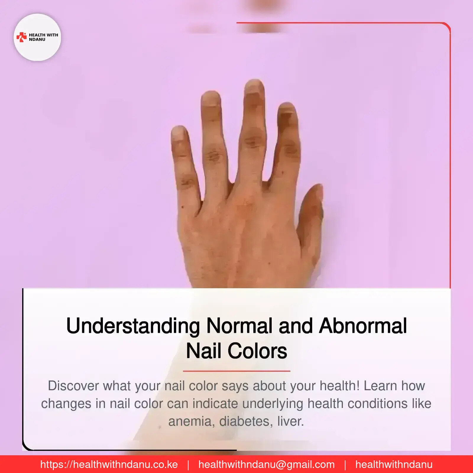 Understanding Normal and Abnormal Nail Colors